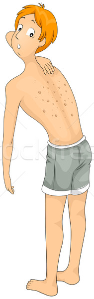 Piele alergie ilustrare om masculin clipart Imagine de stoc © lenm