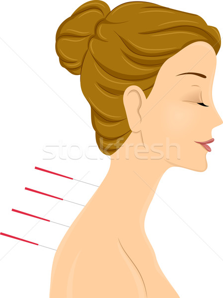 Nina acupuntura ilustración mujer tratamiento arte Foto stock © lenm