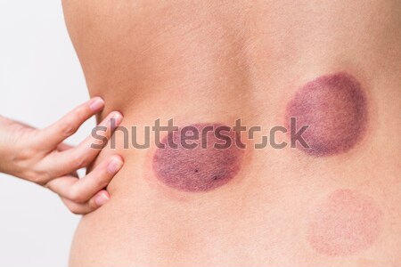 [[stock_photo]]: Blessure · femme · fille · médicaux · sang · fond