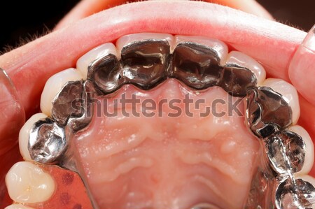 Metal Basis Dental Bridge Stock photo © Lighthunter