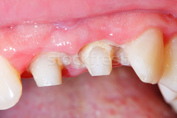 Dental treatment Stock photo © Lighthunter