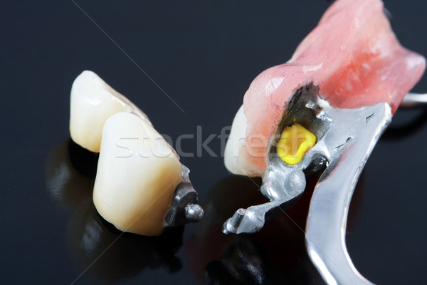 Part of a scheletal prosthesis that replaces missing teeth through special clamping systems and it c Stock photo © Lighthunter