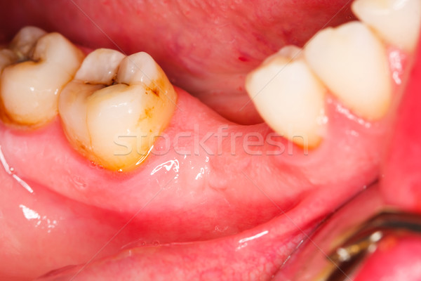 Uman dinţi macro fotografie scadea persoană Imagine de stoc © Lighthunter