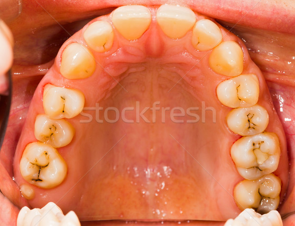 Patient's Denture Stock photo © Lighthunter