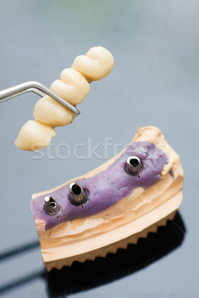 Diş implant kafa köprü dişçi teknisyen Stok fotoğraf © Lighthunter