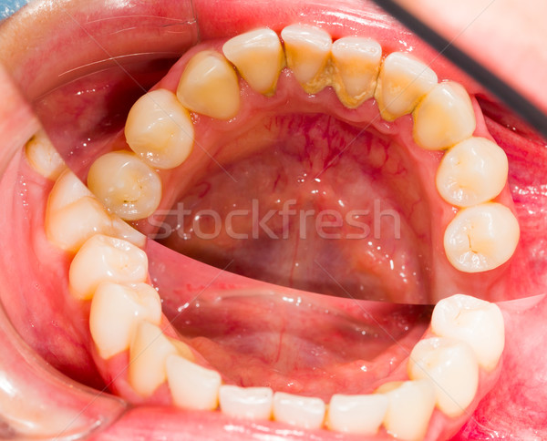 Patient's Denture Stock photo © Lighthunter