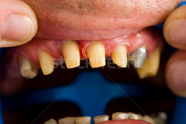 Dientes rehabilitación macro tiro diente dentales Foto stock © Lighthunter