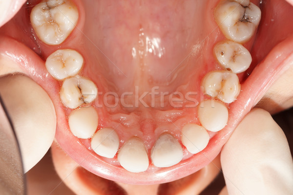Dinţi rar unghi dentar ceramică coroană Imagine de stoc © Lighthunter