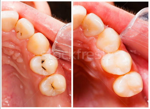 Füllung Material Zähne Behandlung zahnärztliche Stock foto © Lighthunter