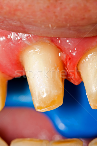 Dişler rehabilitasyon makro atış diş diş Stok fotoğraf © Lighthunter