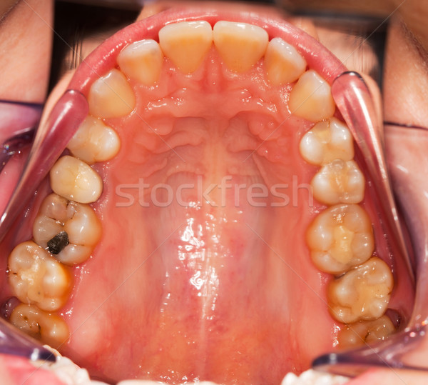 Dental problems Stock photo © Lighthunter