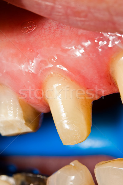 Foto stock: Dientes · rehabilitación · macro · tiro · diente · dentales