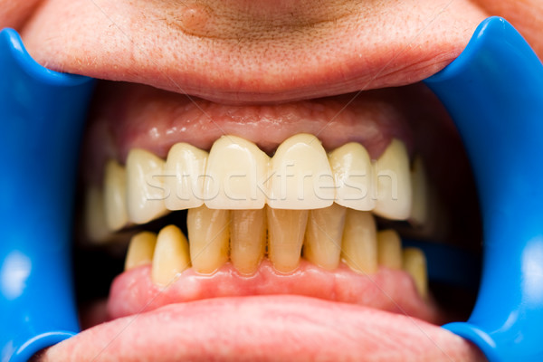 Macro shot of teeth after chiseling, the denture prepared for this patient is documented in my portf Stock photo © Lighthunter