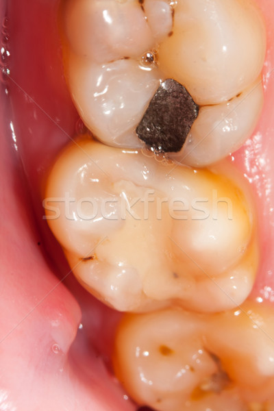 Foto stock: Dentales · problemas · dientes · uno · corona