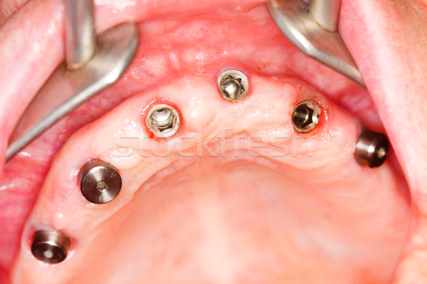 A macro shot of dental implants in the oral cavity (human mouth) - gingival cuffs are being removed  Stock photo © Lighthunter
