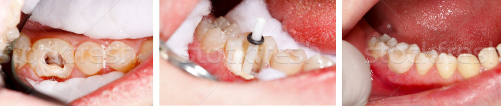 Tooth filling by dentist Stock photo © Lighthunter