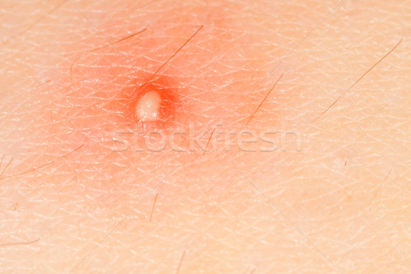 Stock photo: Red pimple