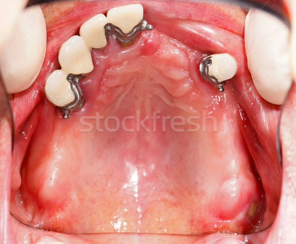 Protézis száj fogászati egészség fogak törődés Stock fotó © Lighthunter