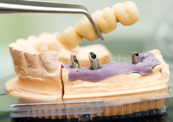 Imagine de stoc: Dentar · implant · cap · pod · dentist · tehnician