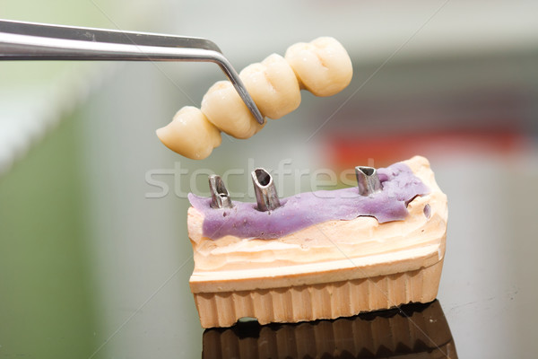 стоматологических имплантат голову моста стоматолога техник Сток-фото © Lighthunter