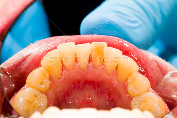 Plaque Entfernung Behandlung Zahnarzt Arbeit medizinischen Stock foto © Lighthunter