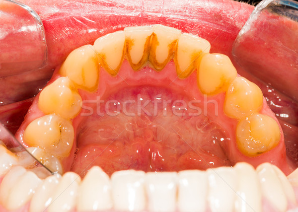 Fogkő fogászati emberi alsó munka orvosi Stock fotó © Lighthunter
