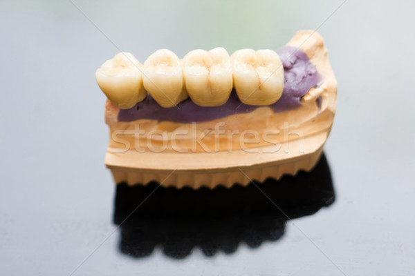 Dental ponte porcellana fissato foto dentista Foto d'archivio © Lighthunter