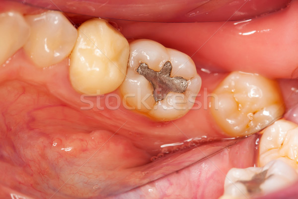 Dental problemi fotografia abbassare denti uno Foto d'archivio © Lighthunter