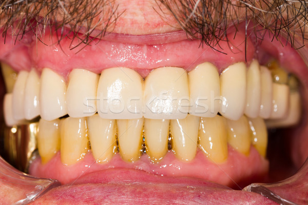 Dental Crowns and Bridges Stock photo © Lighthunter