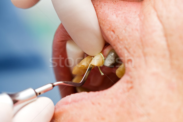 Dental cord placing in gingival sulcus Stock photo © Lighthunter