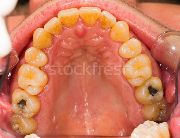 Fogkő eltávolítás emberi fogorvosok iroda fogak Stock fotó © Lighthunter