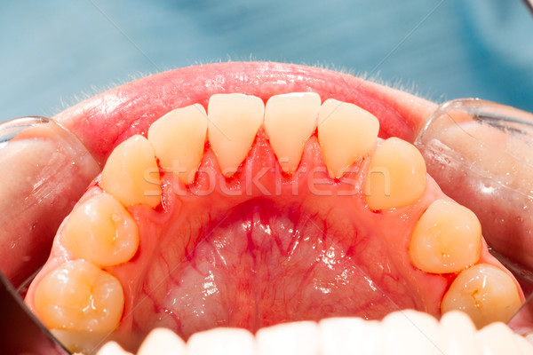 Lower Teeth Stock photo © Lighthunter