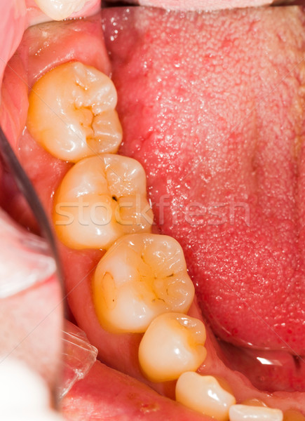Molar Teeth Stock photo © Lighthunter