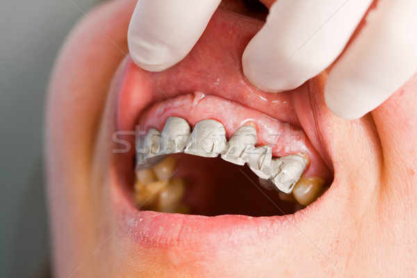 Ustalony dentysta testowanie skuteczność stomatologicznych most Zdjęcia stock © Lighthunter