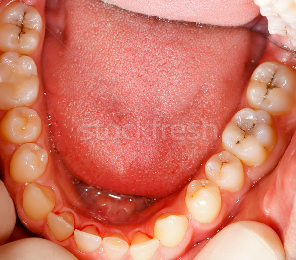 Stockfoto: Holte · tanden · menselijke · behandeling · zeldzaam · hoek