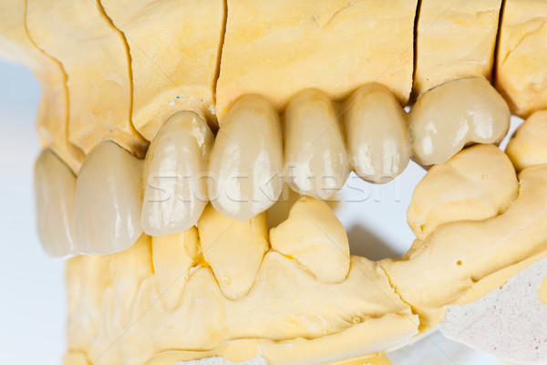 セラミック 歯 歯科 橋 美しい ストックフォト © Lighthunter