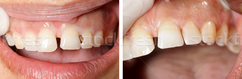Dental filling treatment Stock photo © Lighthunter