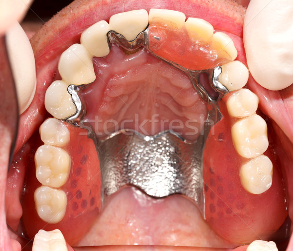 Prothese mond tandheelkundige gezondheid tanden zorg Stockfoto © Lighthunter