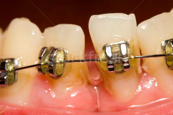 Closing of gap with dental braces Stock photo © Lighthunter