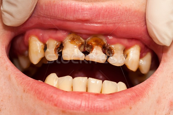 Fogak elhanyagolt orvosi száj férfi fog Stock fotó © Lighthunter
