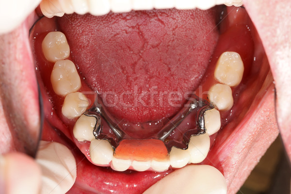 Verlagen prothese mond tandheelkundige gezondheid tanden Stockfoto © Lighthunter
