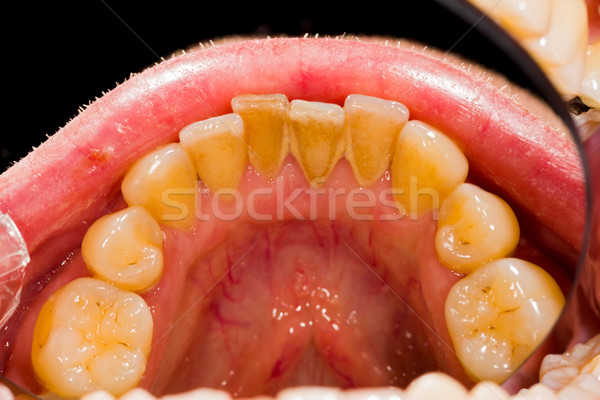 Stock photo: Plaque Removal Treatment