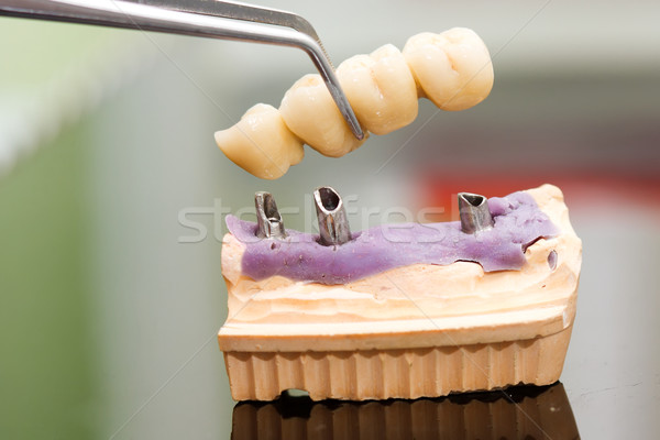 Fogászati implantátum fej híd fogorvos technikus Stock fotó © Lighthunter