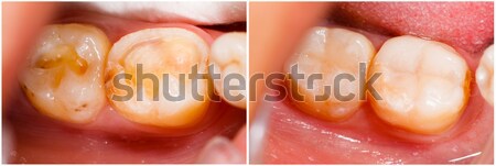 Comnposite filling tooth treatment Stock photo © Lighthunter
