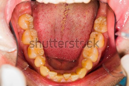 Fogak elhanyagolt orvosi száj férfi fog Stock fotó © Lighthunter