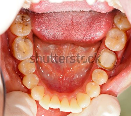 Dental problems Stock photo © Lighthunter