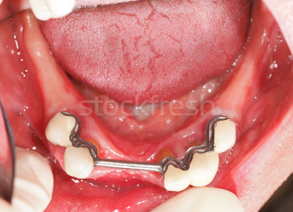 Prothese mond tandheelkundige gezondheid tanden zorg Stockfoto © Lighthunter