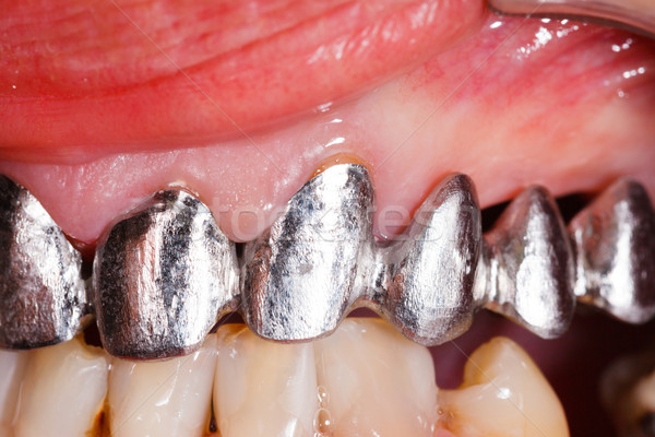 Metal base dental ponte cerâmico boca Foto stock © Lighthunter