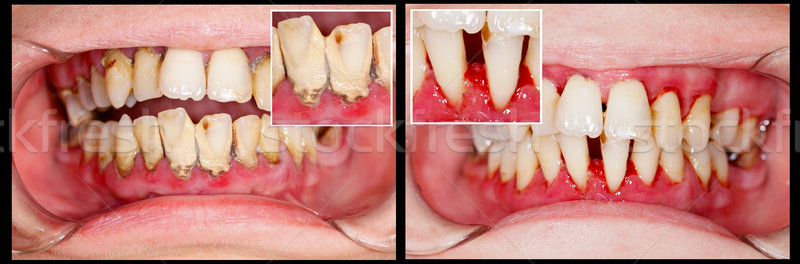 Before and After Treatment Stock photo © Lighthunter