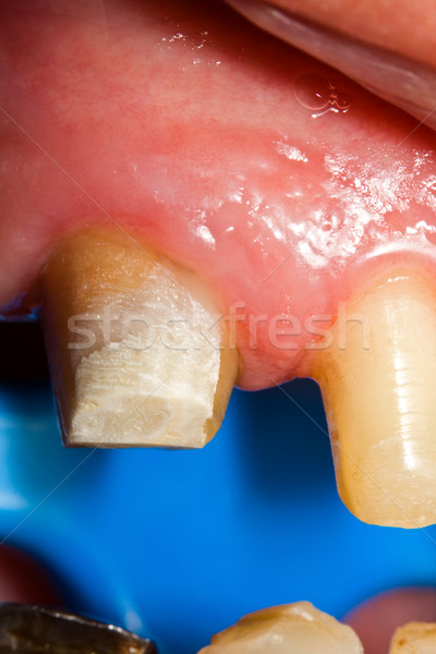 Buffed teeth - prosthetic rehabilitation Stock photo © Lighthunter